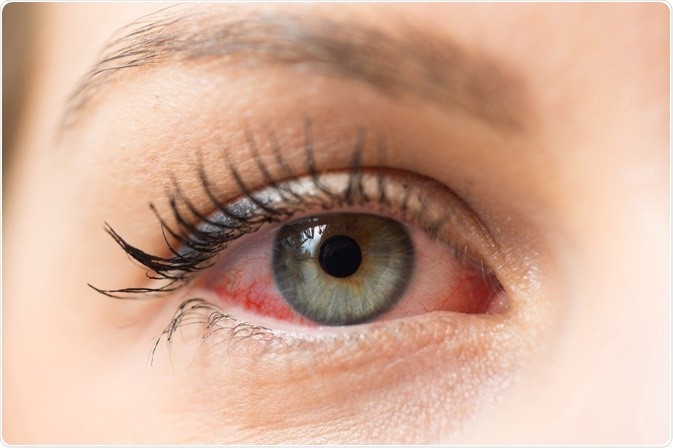 Inflammation and Infection